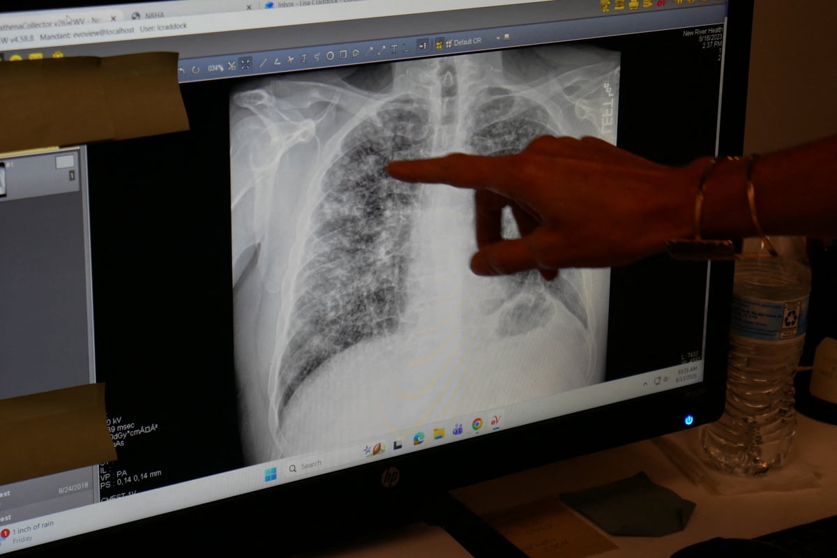Black lung rates soar in West Virginia mining hub