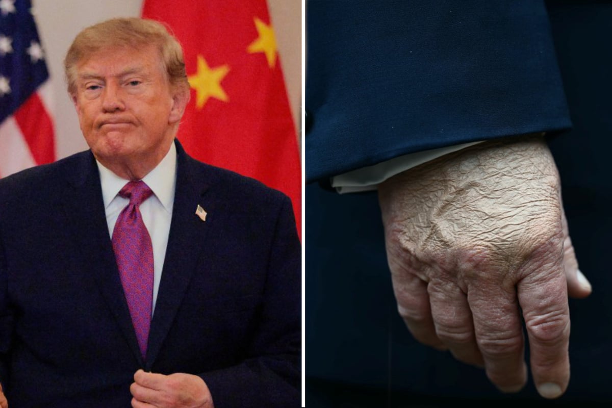 Doctor shares viral hot take on Trump's hands and why it spells "obituary" and "the end is near"
