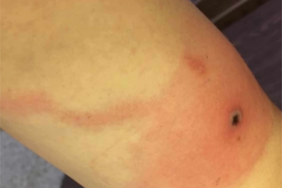 What is Alaskapox? Symptoms to know after first death reported