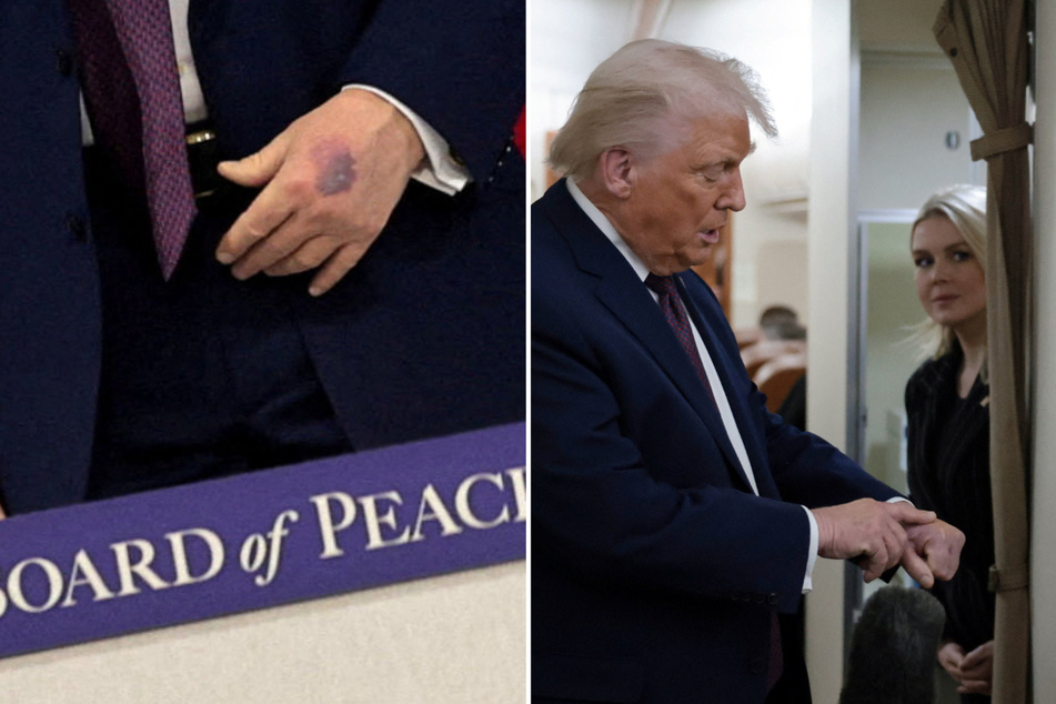 President Donald Trump said a dark bruise on his hand was caused by a combination of hitting a table and taking aspirin.
