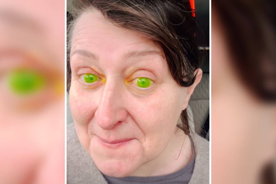 After a visit to the ophthalmologist, Margerita Wargola from Ireland suddenly looked in the mirror to see that she had bright green eyes.