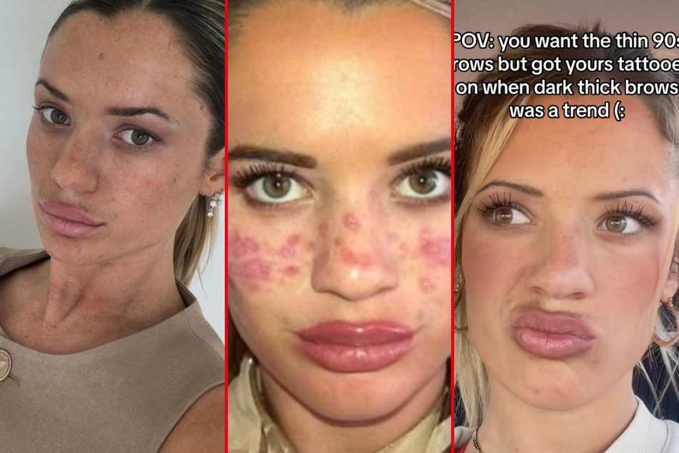 Aussie reality star who went blind from freckle tattoo mishap makes another blunder