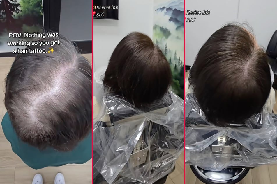 Woman gets "hair tattoo" to cover up hair loss, and the results are impressive!
