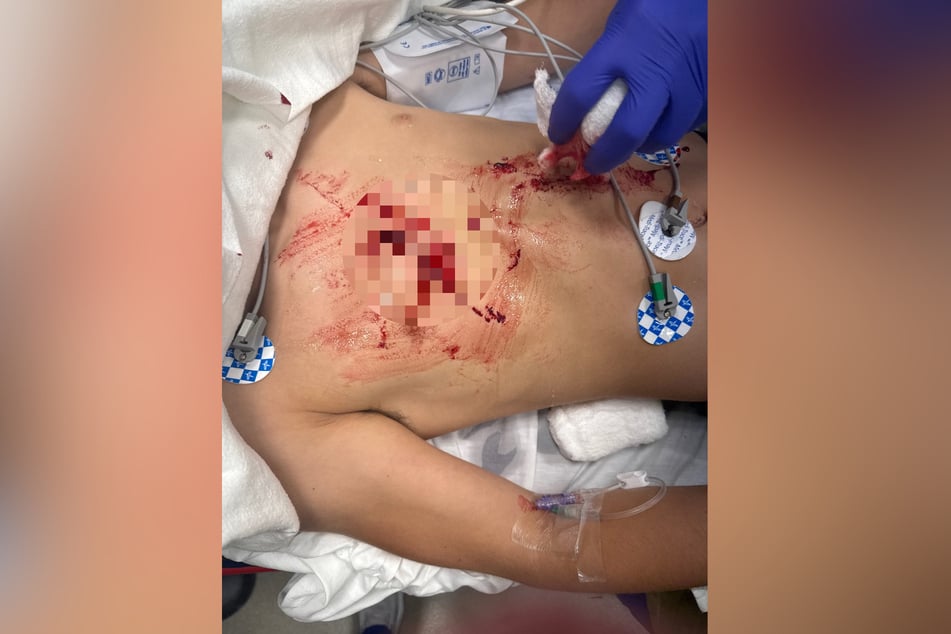 The doctors initially feared a tear in the lung. Fortunately, that wasn’t the case.