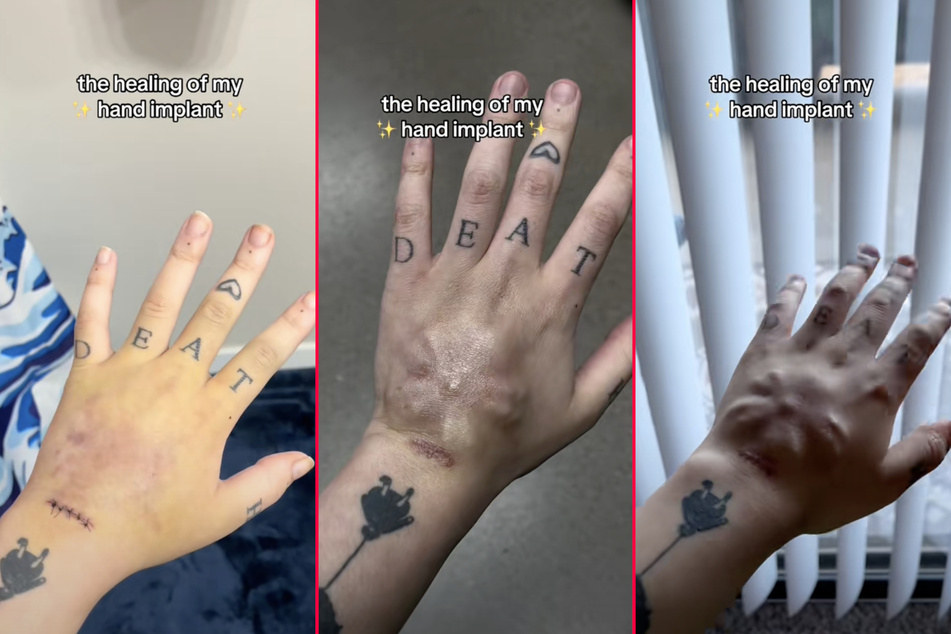 Woman embeds cherry blossom on back of hand in radical body mod