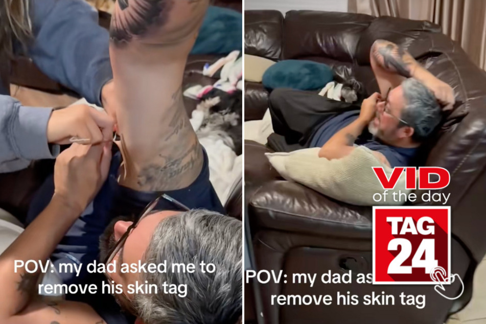 Viral Video of the Day for February 6, 2026: Dad panics after daughter tries risky skin tag removal on couch