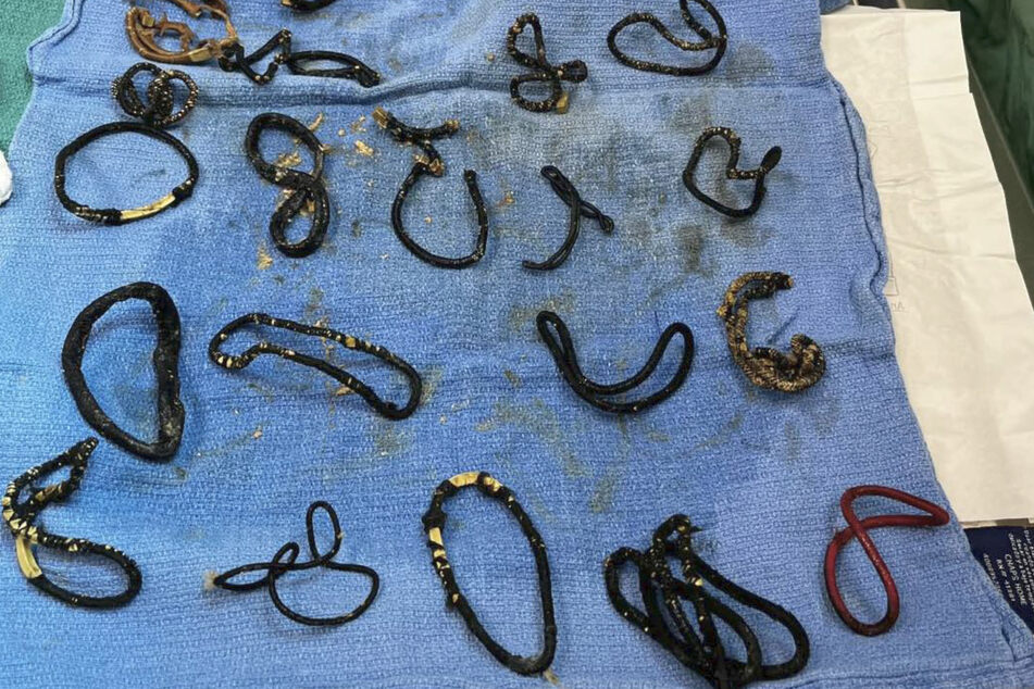 Vets removed 26 hair ties from a little black cat on the brink of death.