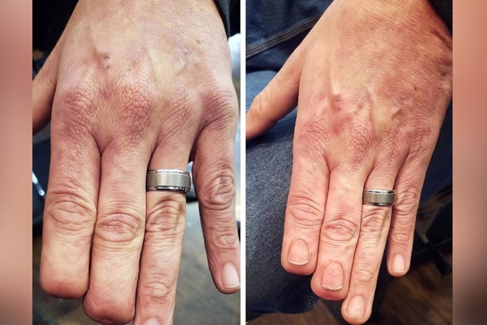 Amazing tattoo artist turns people's scars into art!