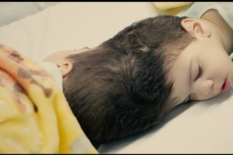 Twins fused at the head and brain go under the knife in miracle surgeries