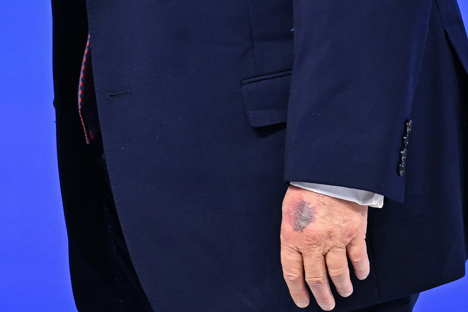 A bruise is visible on the back of US President Donald Trump's left hand as he walks at the Board of Peace meeting during the World Economic Forum (WEF) annual meeting in Davos on January 22, 2026.
