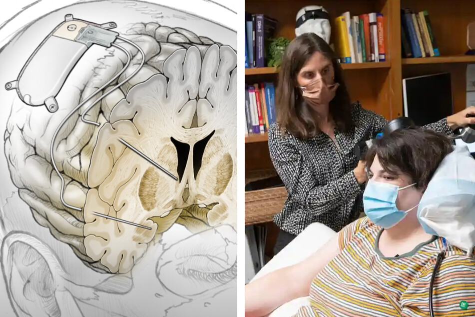 Unprecedented "brain pacemaker" cures severe depression