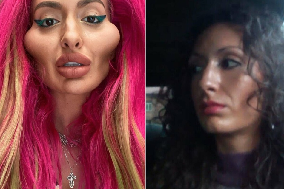 The world's biggest cheekbones? Instagram model is addicted to enhancement procedures