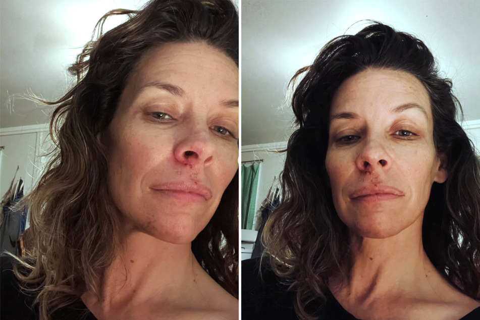 Evangeline Lilly repeatedly showed the progress of her wound healing.