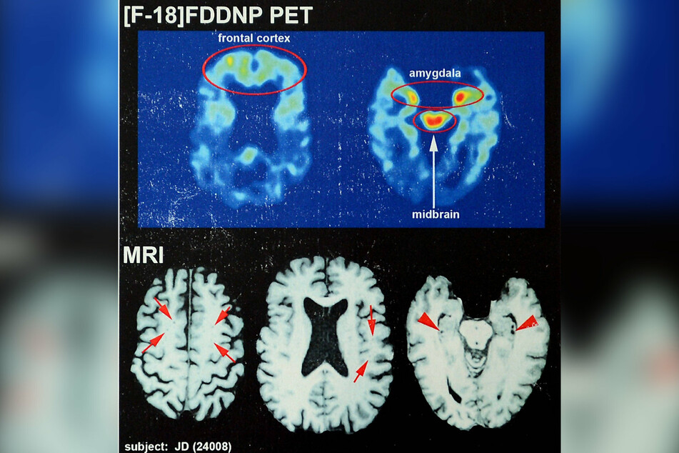 The brain scans of NFL hall of famer Joe DeLamielleure, who was diagnosed with CTE, the brain injury that is affecting so many former players.