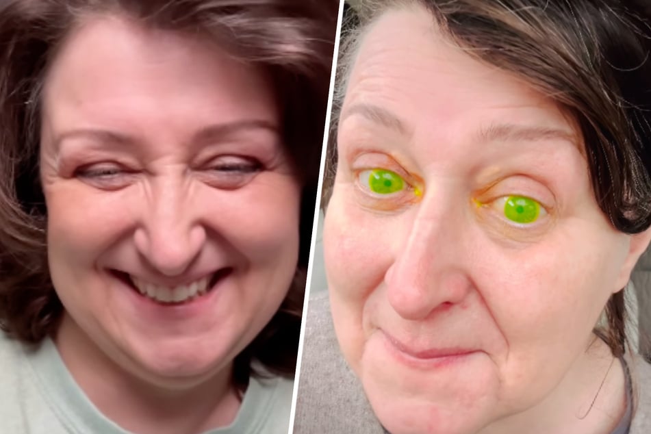 Woman's eyes turn neon green from bizarre medical side-effect: "Not a filter!"