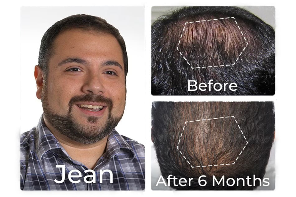 See for yourself how others have benefitted from the Hairmax RegrowMD!