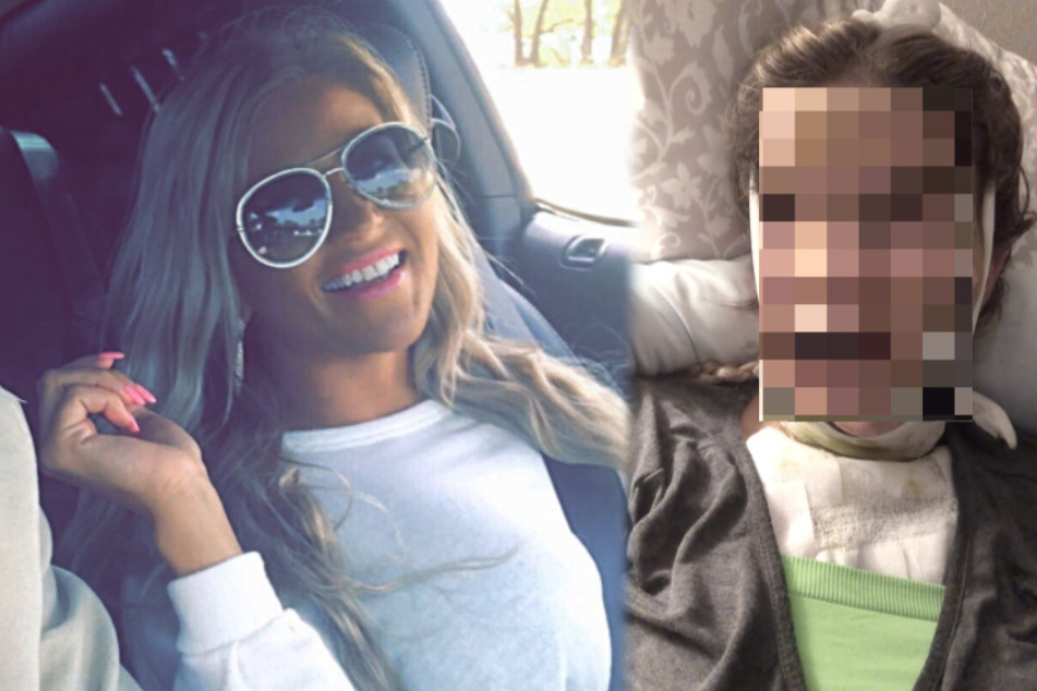 Mother of three suffers severe burns after hand sanitizer explosion