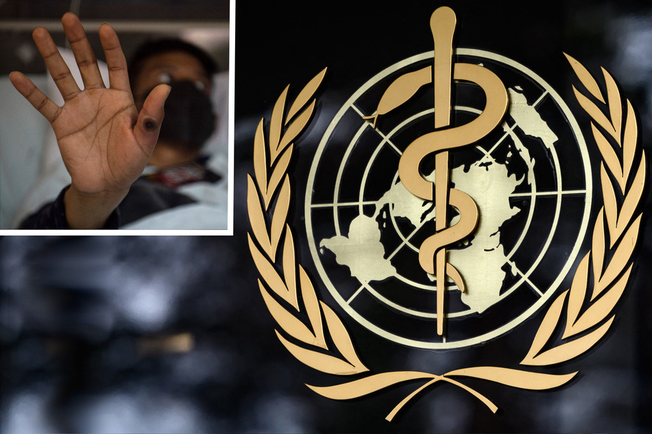 Monkeypox health emergency gets lifted by WHO