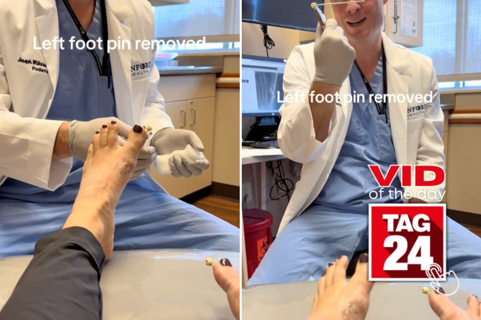 Viral Video of the Day for February 21, 2026: Woman gets huge pin removed from foot – and doesn't even flinch!