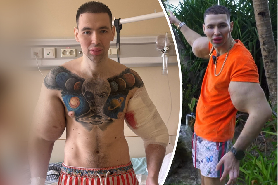 "Russian Popeye" who injected oil into his biceps for years again faces double arm amputation – or even death