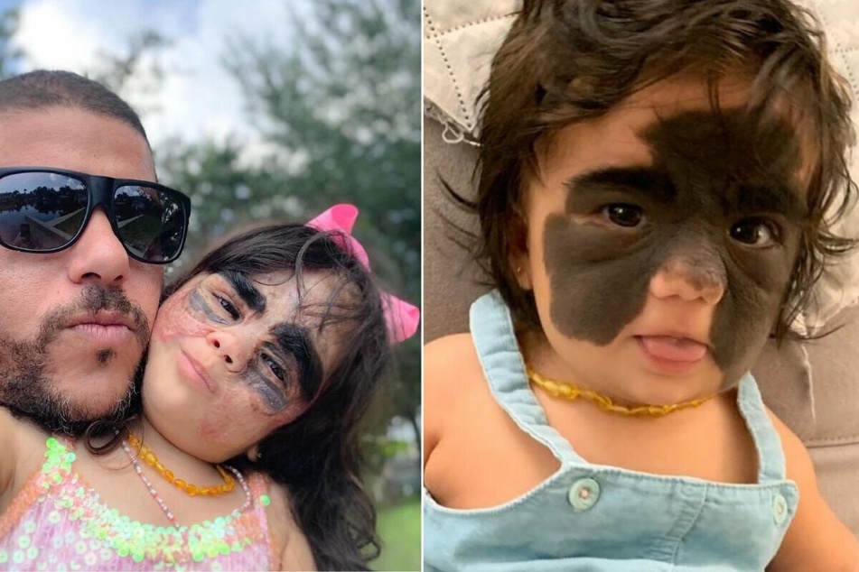 Baby with Batman birthmark, Luna Fenner, gets miracle surgery