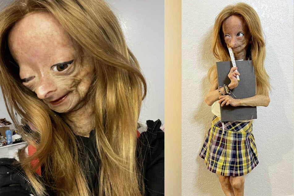 "She touched millions": Teen YouTuber with early-aging syndrome has died