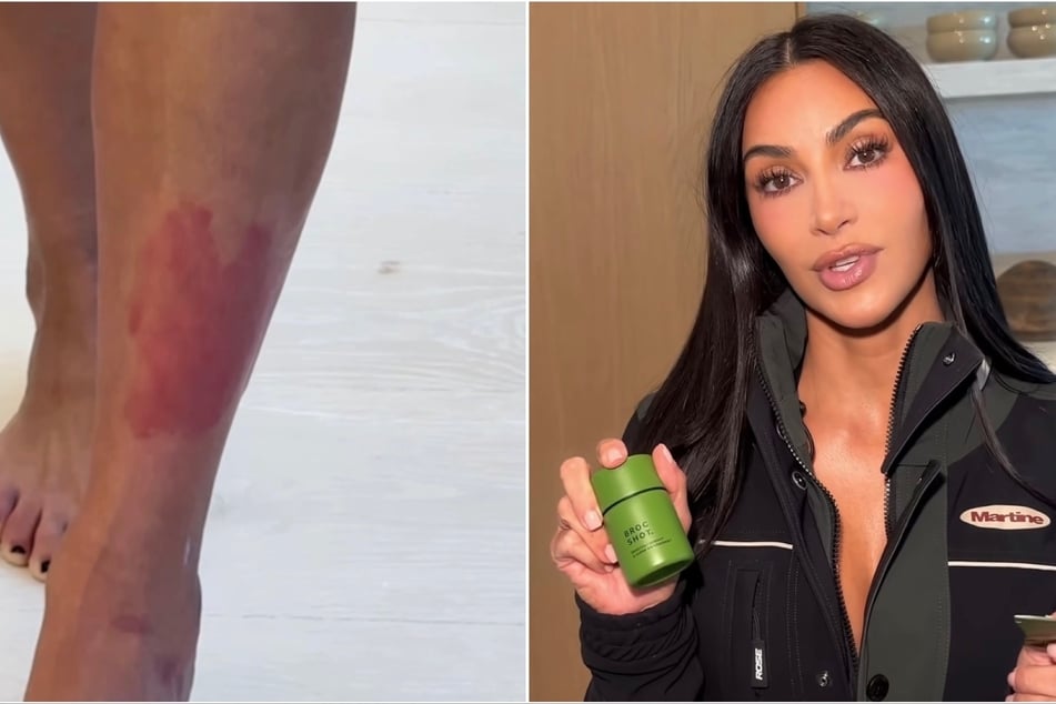 Kim Kardashian backs new Broc Shot after years of dealing with "unbearable" psoriasis