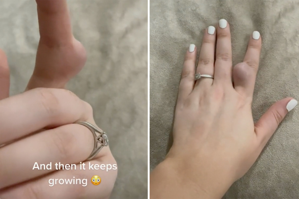 What in the world is this? For months, Hollie Rose Smith had to watch the bump on her finger grow bigger and bigger.