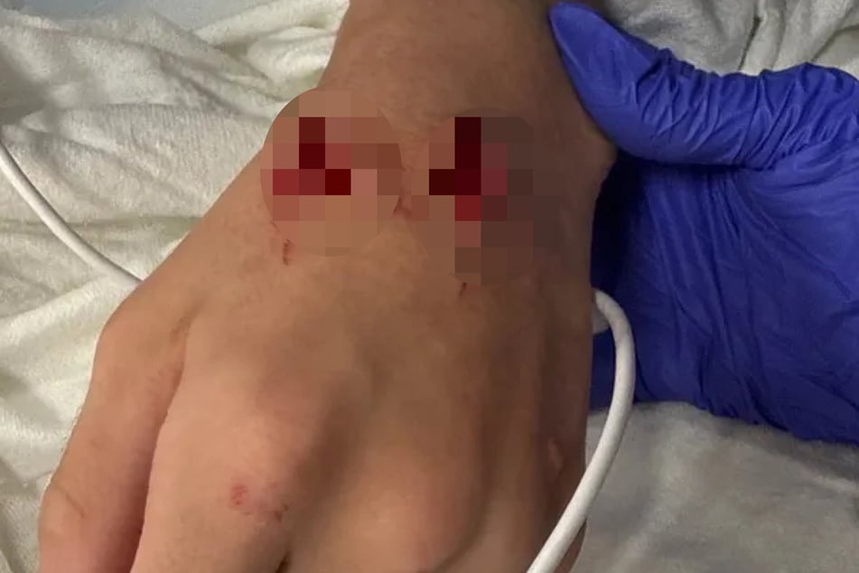 The 13‑year‑old boy also sustained bite injuries on his hand.