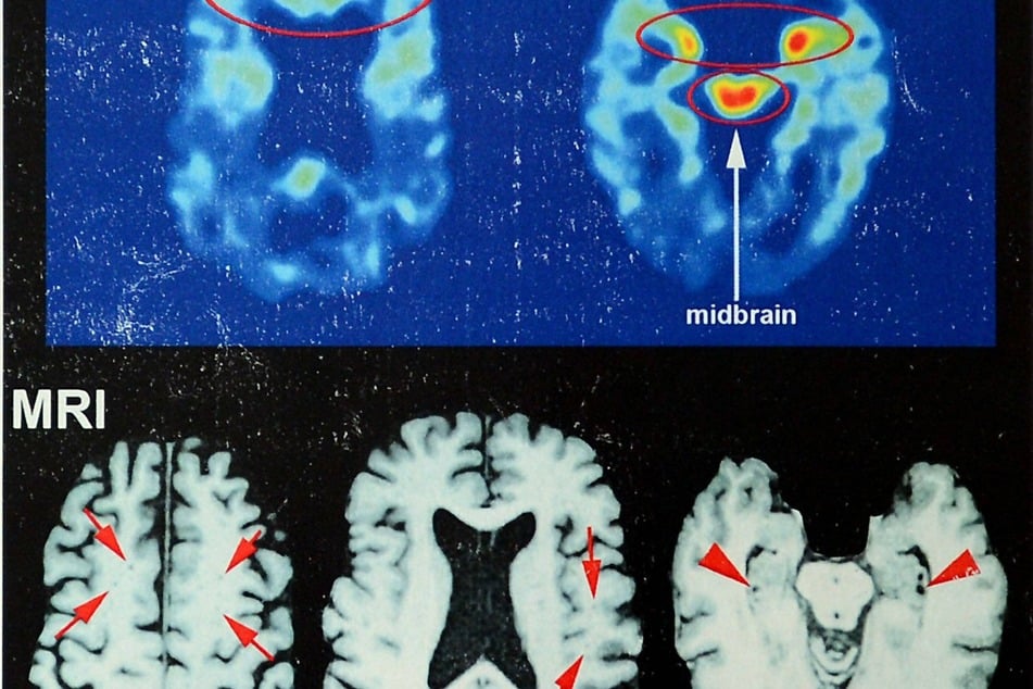 NFL promises to discontinue practice that assumes Black players have a lower brain function