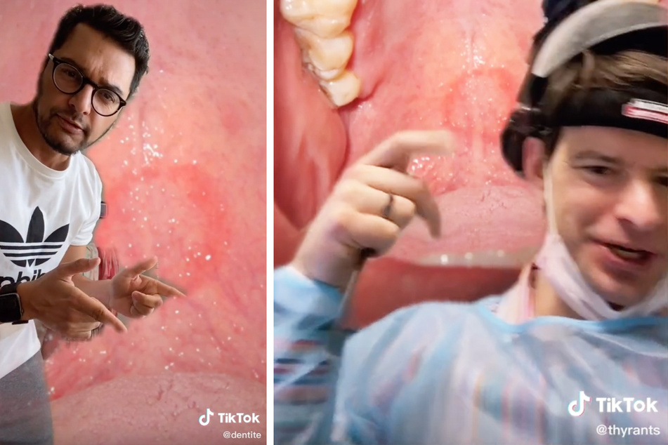 @dentite and @thyrants show the bruising that can occur on the top of the mouth, or soft palate, during a blowjob (collage).
