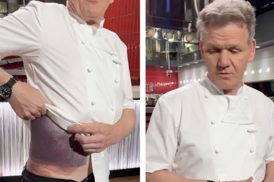 Celebrity chef Gordon Ramsay shows shocking photos of bike accident injuries
