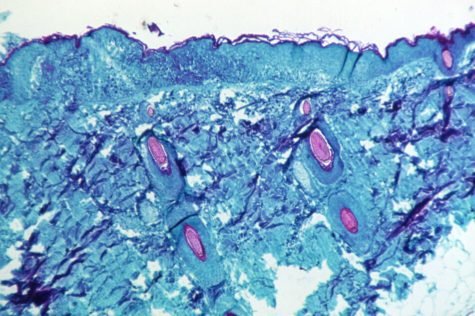 Monkeypox virus detected in New York patient as WHO sounds the alarm