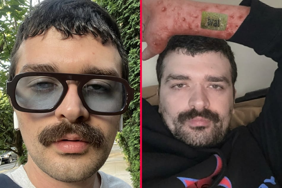 Man hospitalized after his Charli XCX-inspired Brat tattoo gets horribly infected