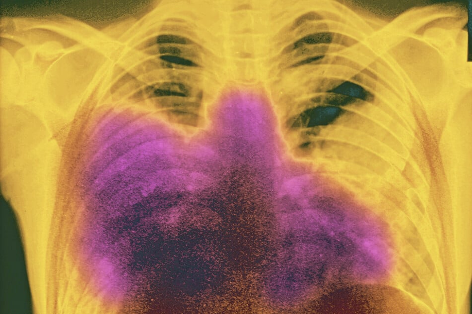 One death confirmed in latest New York City outbreak of Legionnaires' disease