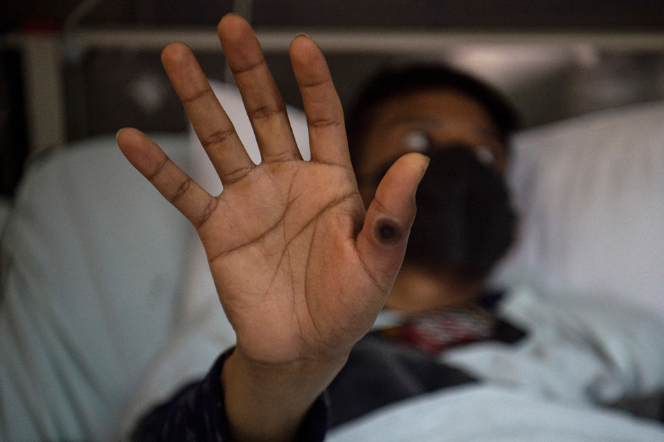 The Democratic Republic of Congo said Thursday an mpox outbreak has killed 548 people there this year.