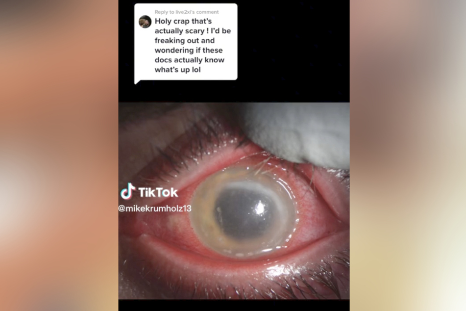 The 21-year-old had a corneal transplant, giving him a chance to regain vision in his right eye.