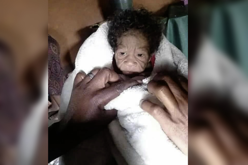 The baby suffers from the rare disease progeria.