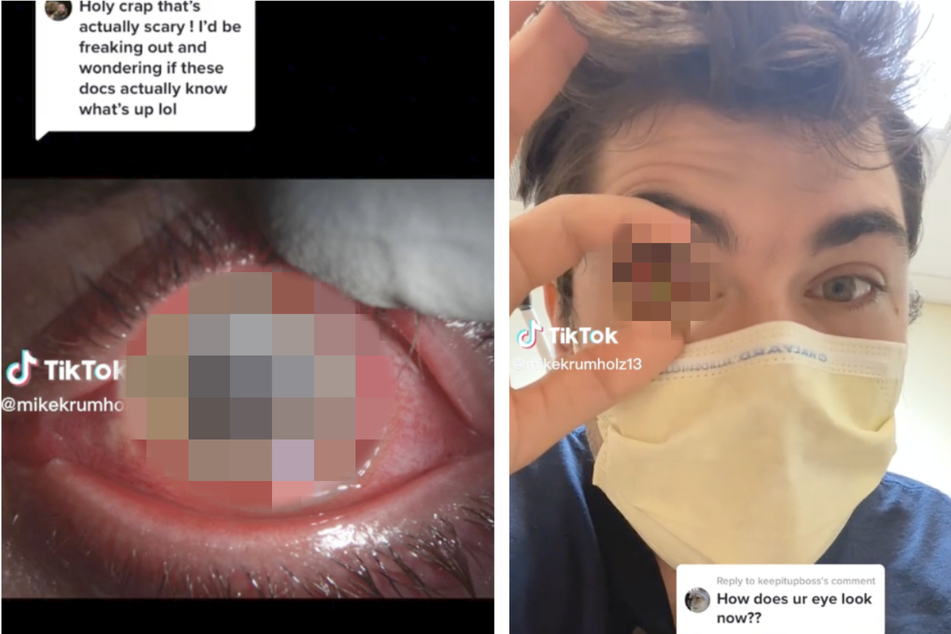 Man's power nap has dire consequences as a parasite eats his eye!